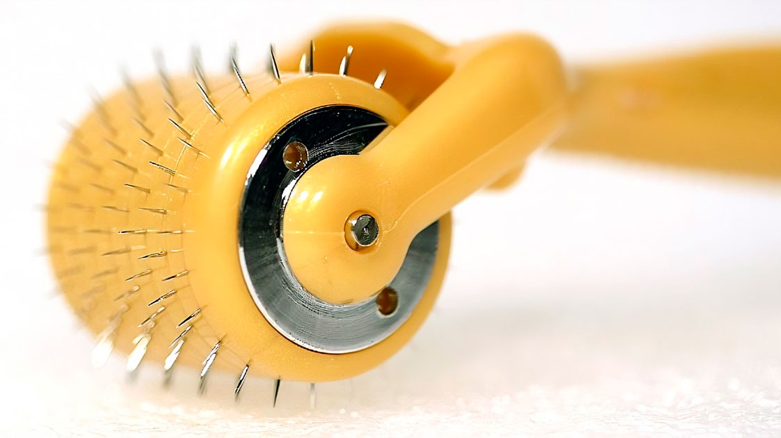 Eficacia del microneedling en cicatrices atróficas de acné. Revisión de la literatura